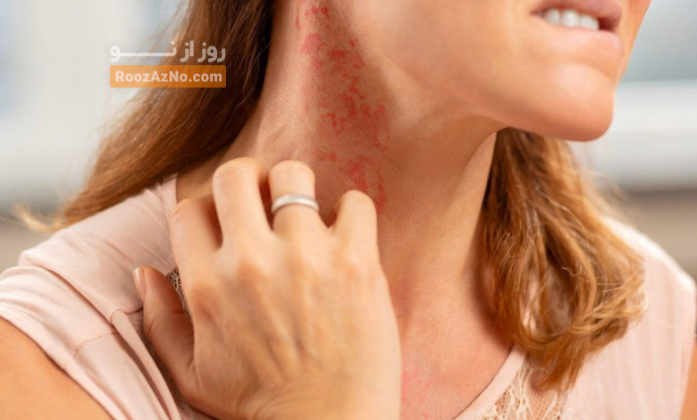 
حساسیت-به-نقره